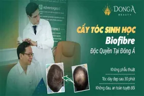 Cấy tóc sinh học không phẫu thuật Biofibre – Phục hồi tóc chắc khỏe